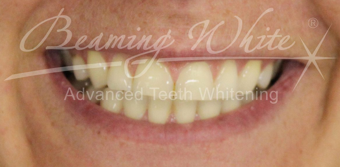 Dental Bib Clips - Beaming White